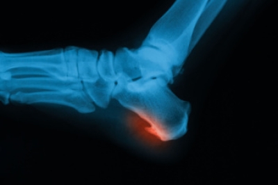 Facts About Heel Spurs