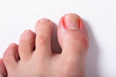 Care for Ingrown Toenails