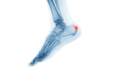 Definition and Symptoms of Heel Spurs