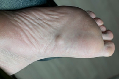 Understanding Plantar Fibroma