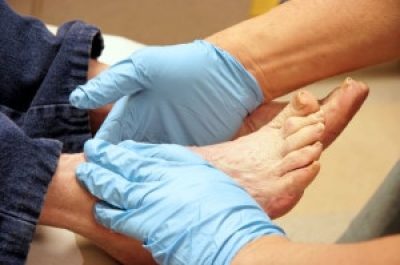 Diabetes and Foot Wound Healing